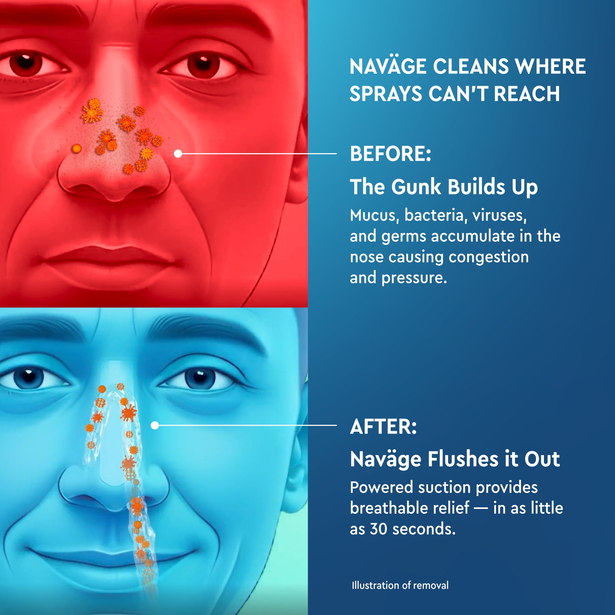 Naväge Deluxe Bundle: Nose Cleaner, 30 SaltPods, Countertop Caddy, Travel Bag